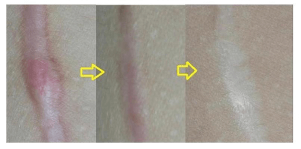Fractional Laser Treatment Fractional Laser Treatment